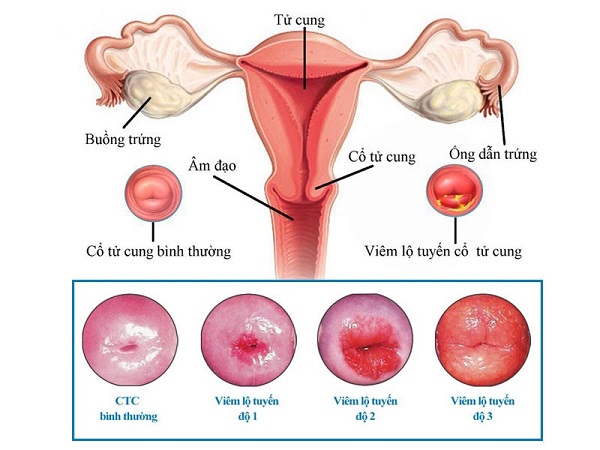 Hình ảnh viêm nhiễm phụ khoa - viêm lộ tuyến cổ tử cung